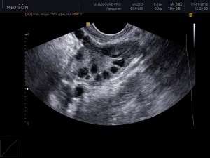 УЗИ органов малого таза